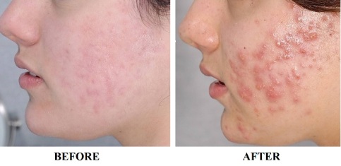 What a difference! (courtesy of www.skinsecretsmedicalspa.com)